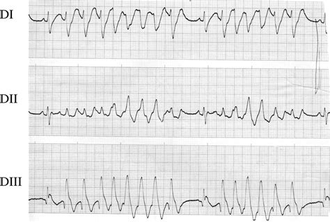 Clinical Aspects and Prognosis of Brugada Syndrome in Children ...