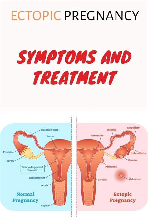 Ectopic Pregnancy Symptoms And Treatment Artofit