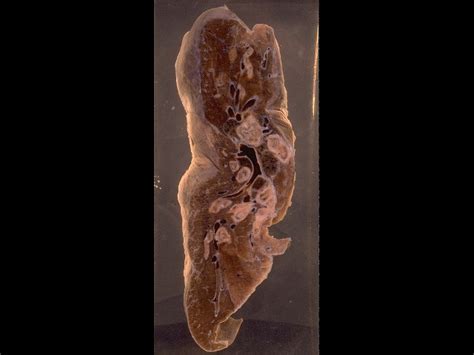 This Specimen Shows A Cross Section Of A Lung From An Asthmatic With