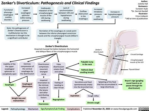 Zenker’s Diverticulum Pathogenesis And Clinical Findings Calgary Guide