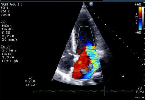 Apical Four Chamber View Colour Doppler Showing A Single Severe Mitral