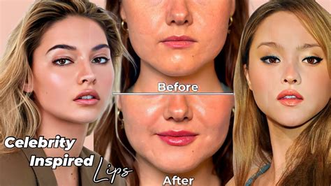 Before After Lip Filler Incredible Results The First Time With Only