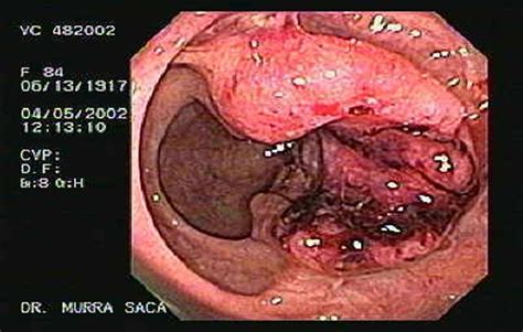 C Ncer Del Colon Gastroenterologia El Salvador Murrasaca