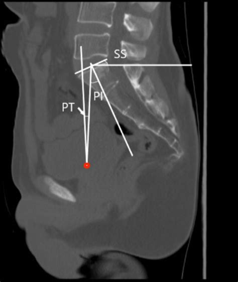 Validity And Reliability Of Spinopelvic Parameters Measured On Computed