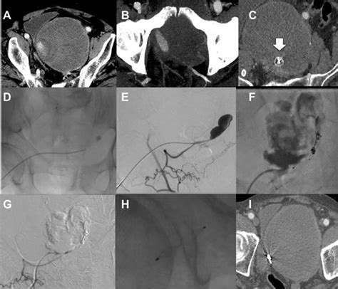 Fig A C Preoperative Computed Tomography Angiography Cta Showing