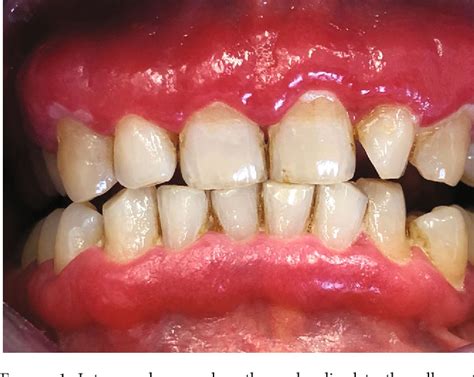 Pdf Plasma Cell Gingivitis Treated With Photobiomodulation With No