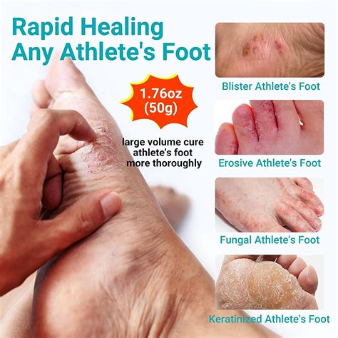 LMNOOP Athletes Foot Treatment Cream Maximum Strength For Athlete S