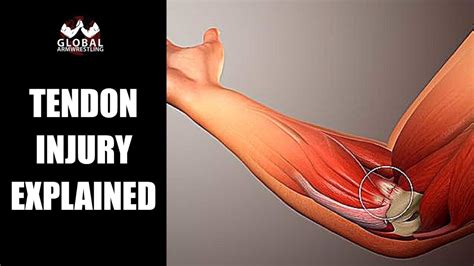 Tendinopathy 101 The Science Behind Elbow Pain In Arm Wrestling Youtube