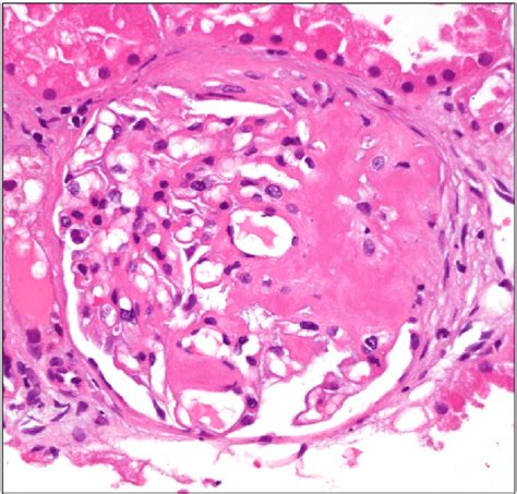 Light Microscopic Image ×400 Demonstrating Eosinophilic Material