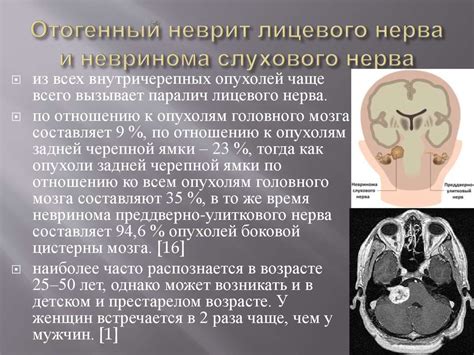 Отогенный неврит лицевого нерва - презентация онлайн
