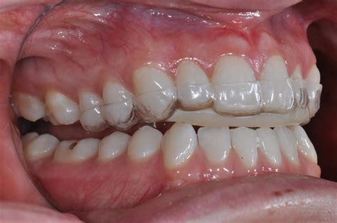 Occlusal Appliance Selection Process: Which One and Why? - Restorative