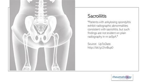 11 Conditions That May Indicate Axial Spondyloarthritis