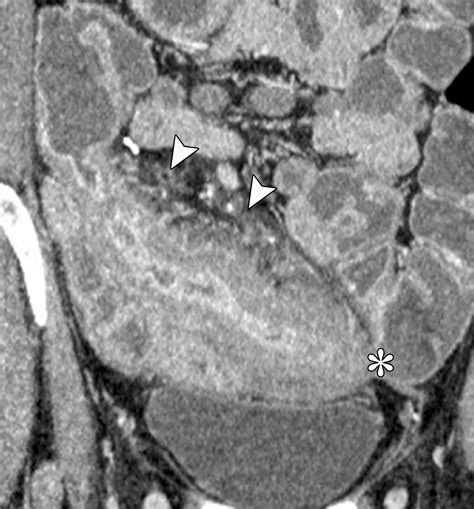 Ct Findings Of Acute Small Bowel Entities Radiographics