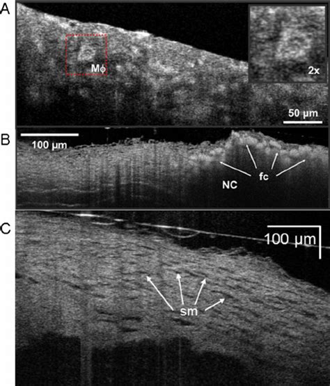 M Axial M Lateral Resolution Oct Images Of Human Coronary