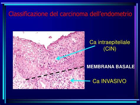 Ppt Tumore Della Cervice Uterina Powerpoint Presentation Id