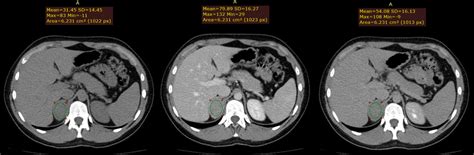 20-year old male with a rounded homogenous right adrenal lesion ...