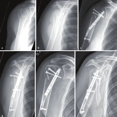 Abb Eine J Hrige Patientin Mit Part Fraktur Des Proximalen