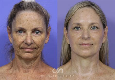 Facelift Before And After Artofit