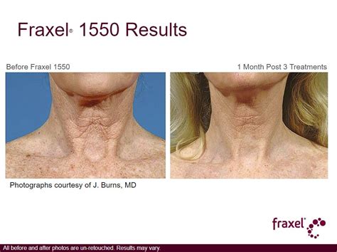 Fraxel Healthy Image