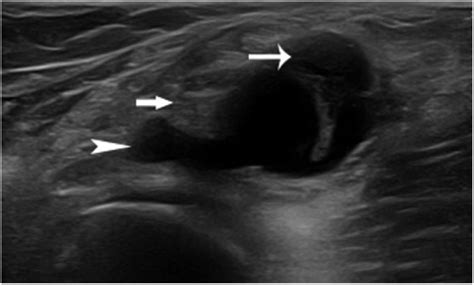 The Sonographic Spectrum Of Baker Cysts Tony Y Li