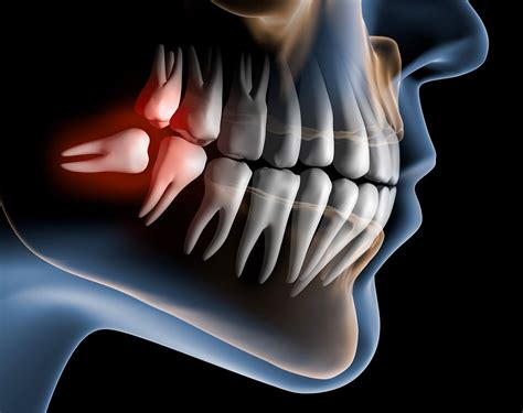 Wisdom Tooth Extraction Removal Parramatta Castle Hill