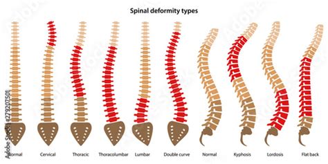 Spinal Deformity Types Anterior View And Lateral View Of Spinal