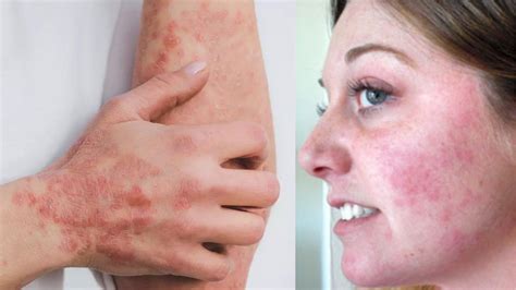 Kelebek Hastalığı Lupus nedir Kelebek Hastalığı Lupus belirtileri