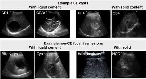 Example Ultrasound Images Of Focal Liver Lesions In Differential