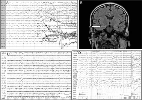 Figure Patient 1 S Ictal EEG And Brain MRI And Patient 2 S Ictal EEG