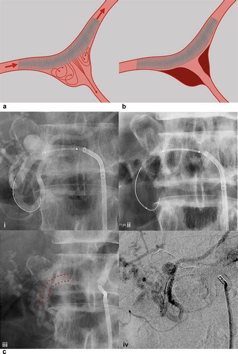 Treatment Of Visceral Artery Aneurysms Using Novel Neurointerventional Devices And Techniques