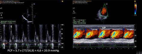 C Lculo Da Press O Capilar Pulmonar Pela Ecocardiografia Blog Ecope