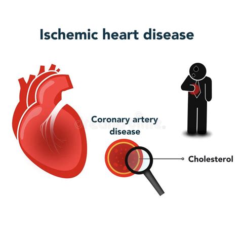 Ischemic Heart Stock Illustrations Ischemic Heart Stock