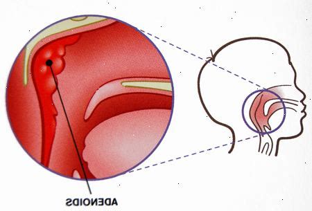 Tonsillektomie Und Adenotomie Kind Bluake