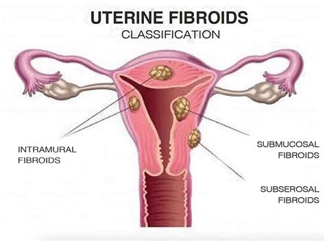 Uterine Fibroids Or Myomas Causes Symptoms And Treatment