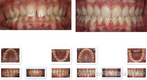 重庆哪里做牙齿矫正比较好？ 知乎