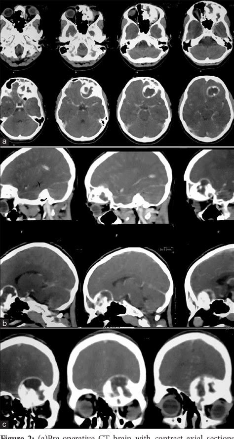 Figure From Transcranial Resection Of A Juvenile Psammomatoid