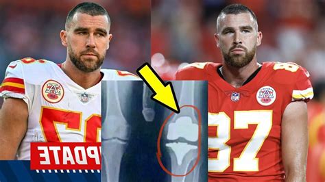 Travis Kelce Injury Update KC Chiefs TE Travis Kelce Brutal Knee