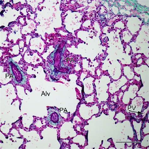 Lung Biopsy Specimen From Patient 1 Showing Well Expanded And Download Scientific Diagram