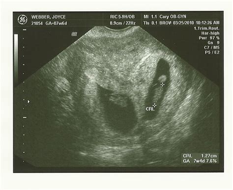 Two for One Special: 8 Week Ultrasound Pictures