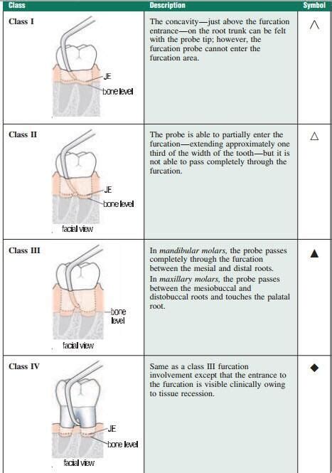 Furcation Involvement Dental Hygiene Student Dental Hygiene School