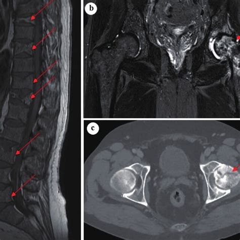 Sagittal T Weighted Mri Of Lumbar And Thoracic Spine A Showing