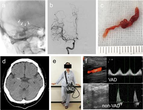 Complete Recanalization After Thrombectomy Case 1 The Image Shows A Download Scientific