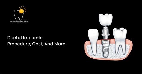 Dental Implants: Procedure and Cost in Mumbai
