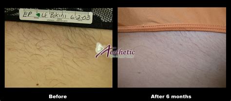 Laser Hair Removal Before & After Photos Pittsburgh PA