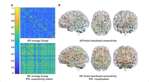 Figure Comparison Of Whole Brain Functional Connectivity Between The Ad Download Scientific