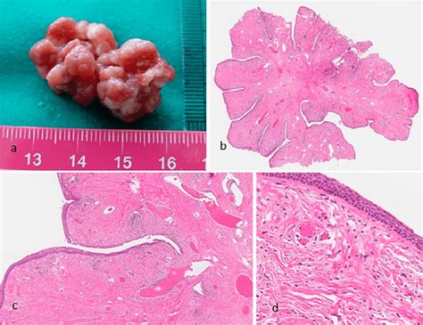 Macroscopic A And Microscopic Be Examination Of Removed Tissue Hot