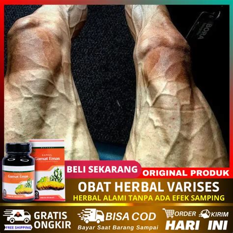 Obat Varises Kaki Penghilang Varises Di Kaki Betis Tangan Dan Paha Urat