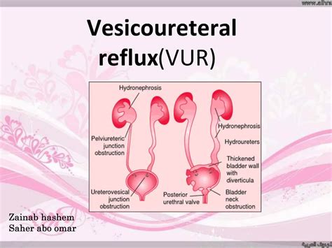 Ppt Vesicoureteral Reflux Vur Powerpoint Presentation Free Download