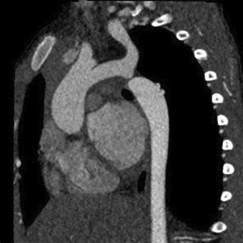 Sagittal Image Of The Aortic Arch Demonstrates Severe Coarctation Download Scientific Diagram