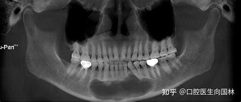 【囊肿手术案例】大型颌骨角化囊肿开窗减压联合囊肿塞治疗 知乎